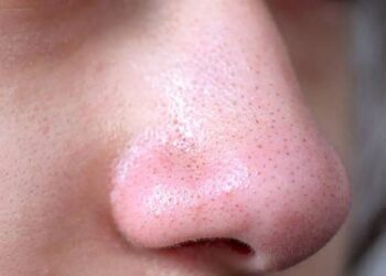 ಮುಖದಲ್ಲಿ ಬ್ಲಾಕ್ ಹೆಡ್ಸ್ ಹಾಗೂ ವೈಟ್ ಹೆಡ್ಸ್ ಇದ್ಯಾ? ಟಿಪ್ಸ್ ಇಲ್ಲಿದೆ!