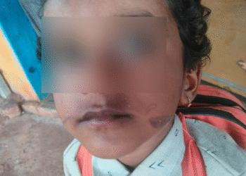 ಅಂಗನವಾಡಿಯಲ್ಲಿ ಜಗಳವಾಡಿದ ಬಾಲಕನಿಗೆ ಬರೆ ಹಾಕಿದ ಸಹಾಯಕಿ ; ಪೋಷಕರ ಆರೋಪ